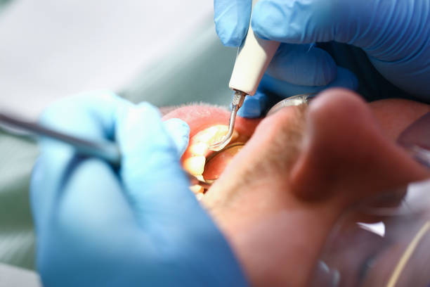 Best Emergency Dental Care for Broken or Chipped Teeth in Pilot Mountain, NC
